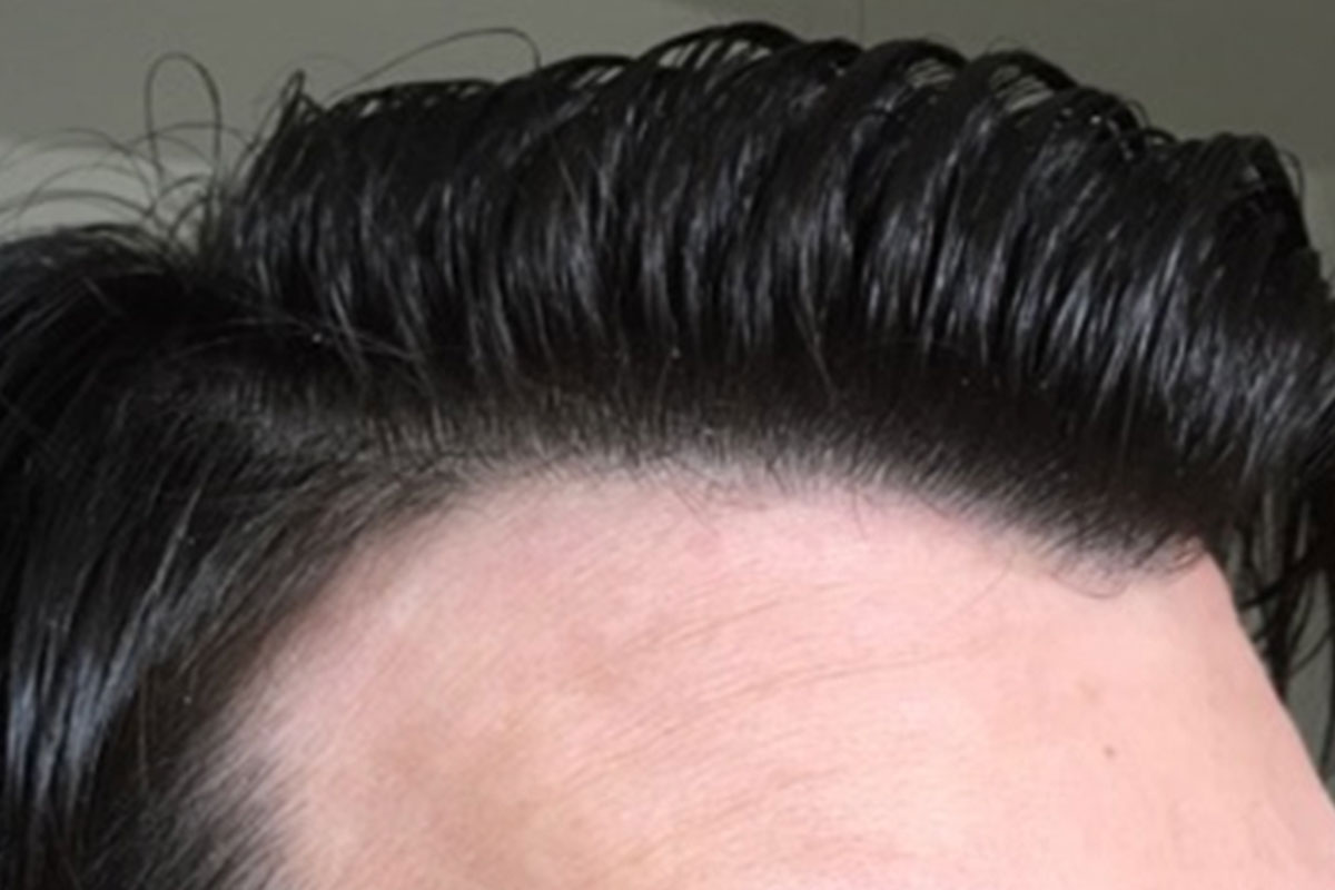 after hair restoration indianapolis