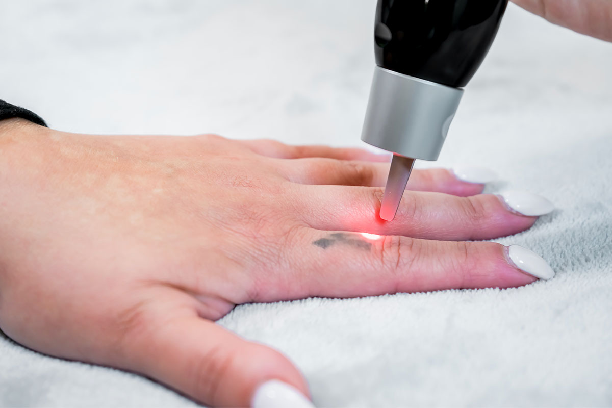 laser tattoo removal
