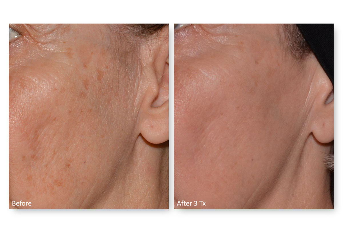 woman before and after laser skin resurfacing indianapolis
