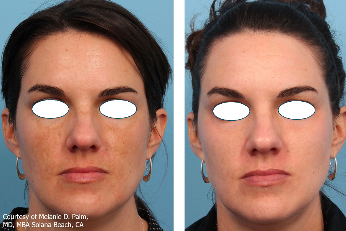 woman before and after laser skin resurfacing indianapolis