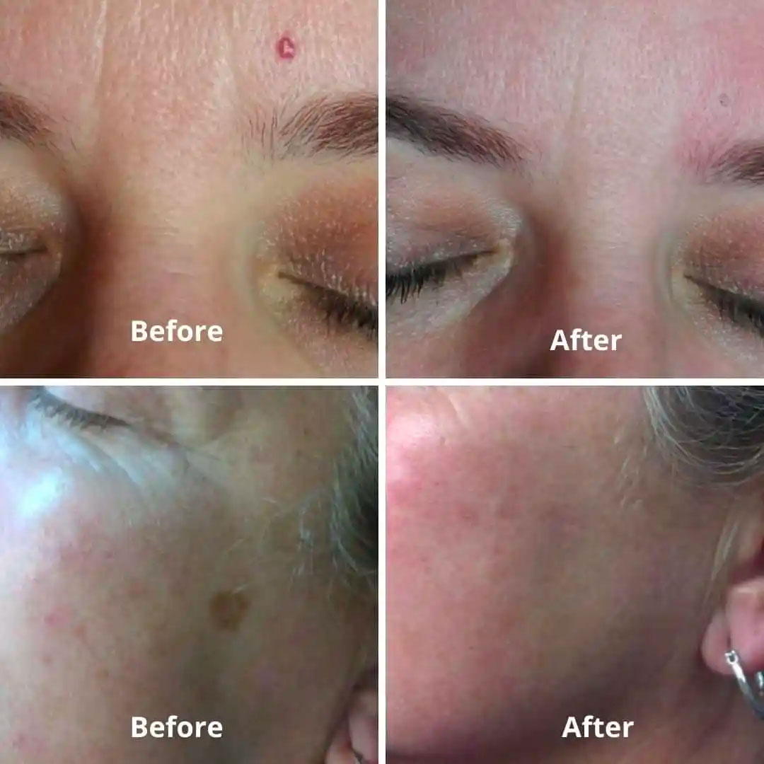 before and after skin rejuvenation indianapolis