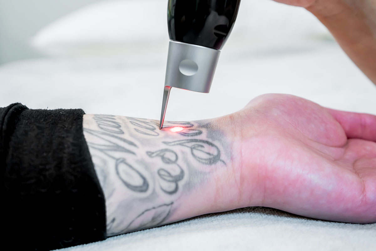 Tattoo Removal FAQ in Indianapolis, IN Skin Renew Day Spa